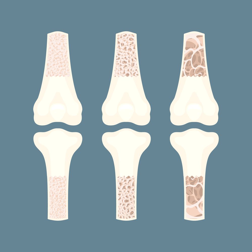 Osteoporosis bone density loss disease medical infographics